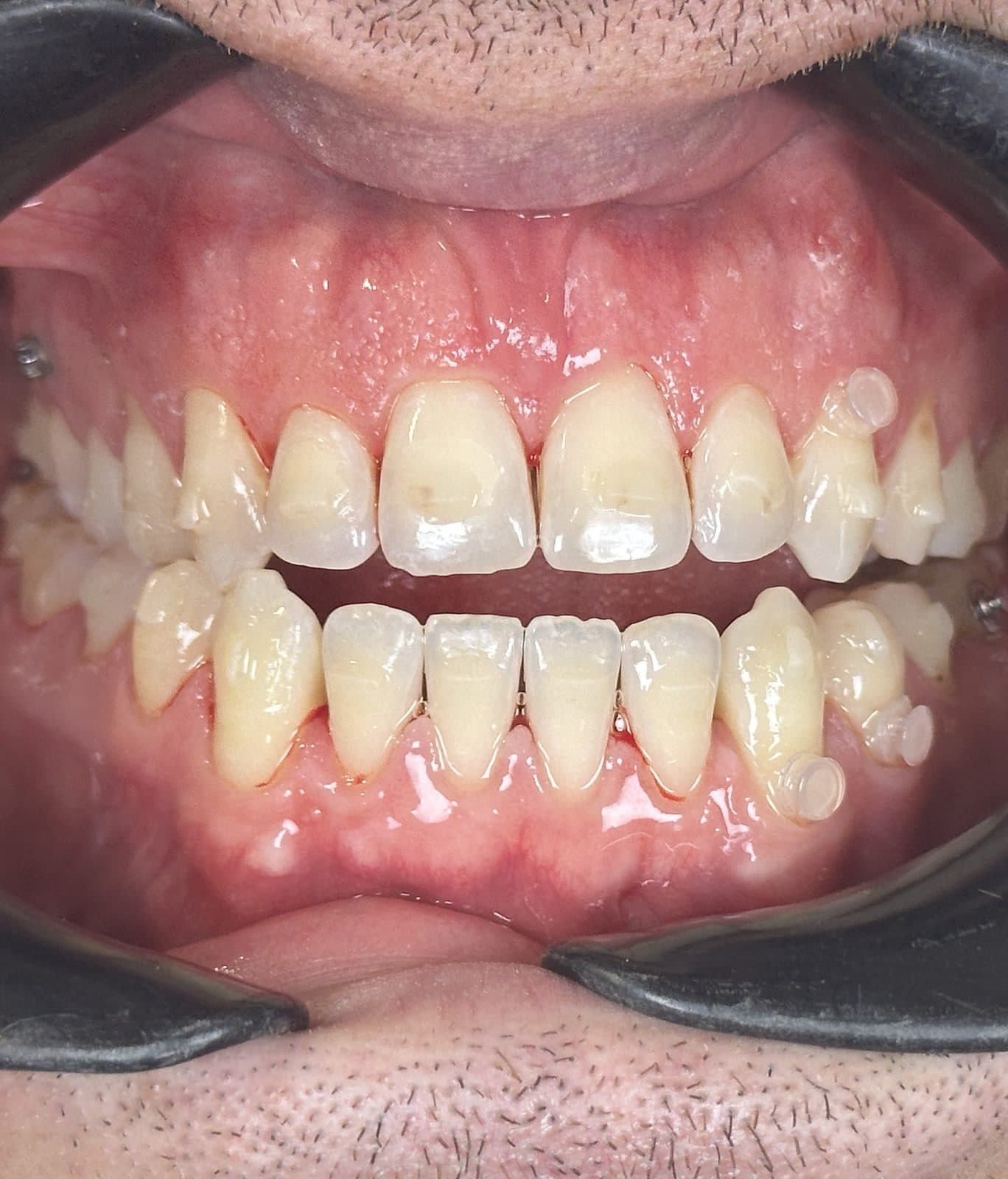 After: close-up of teeth and gums