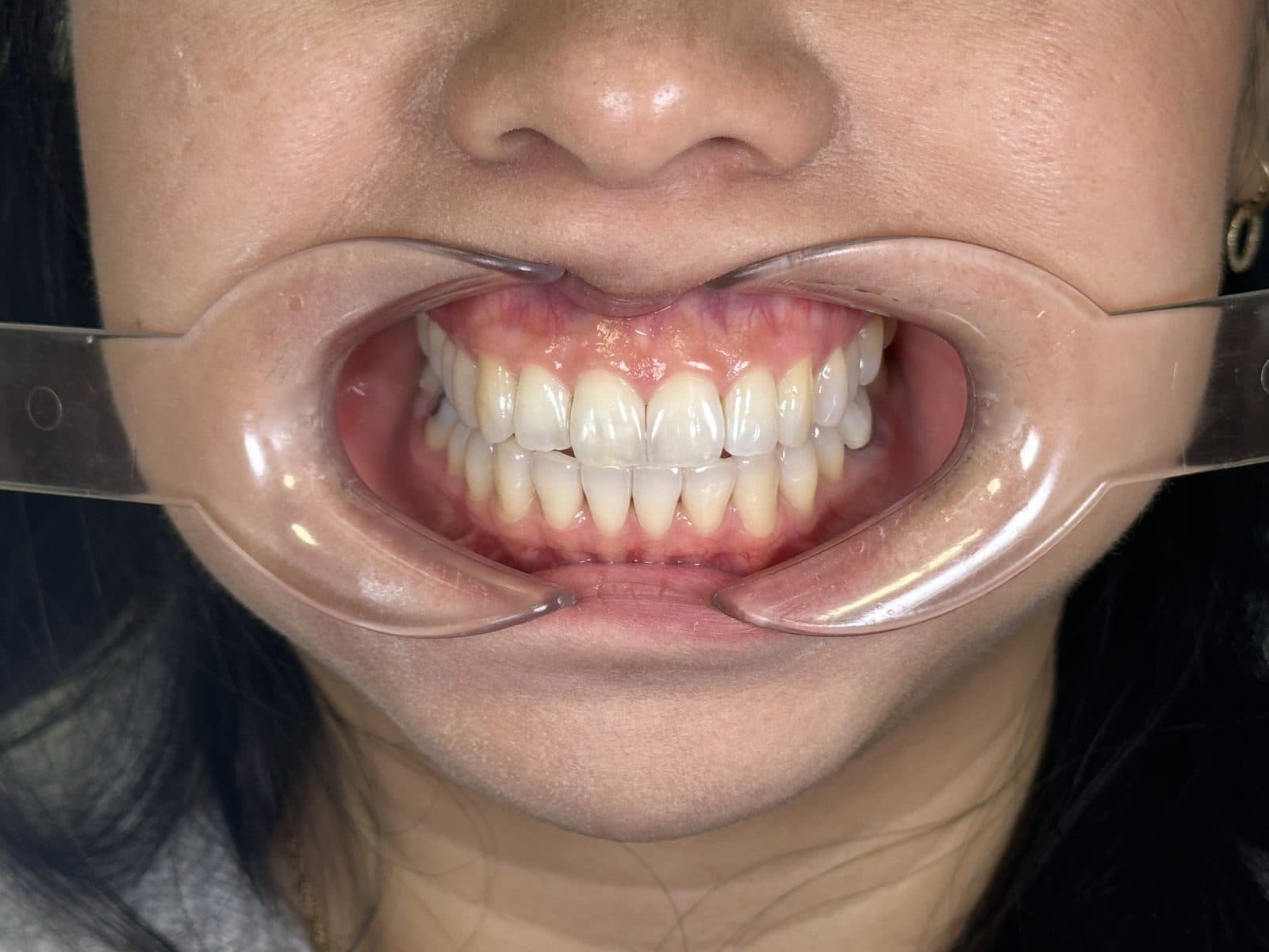 Before: close-up of teeth and gums