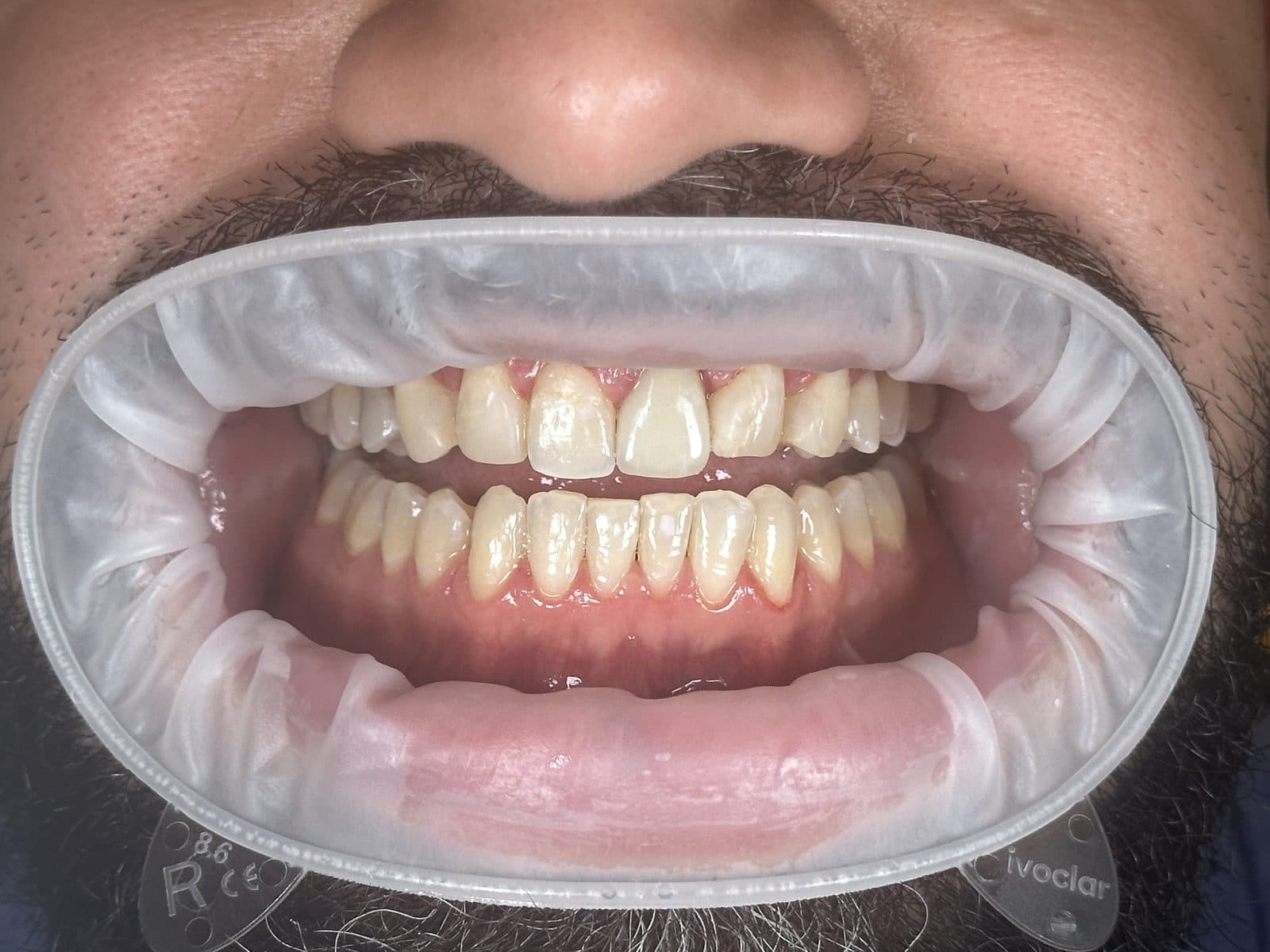 After: close-up of teeth and gums