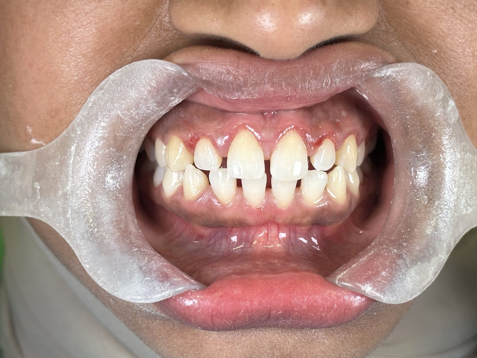 After: close-up of teeth and gums