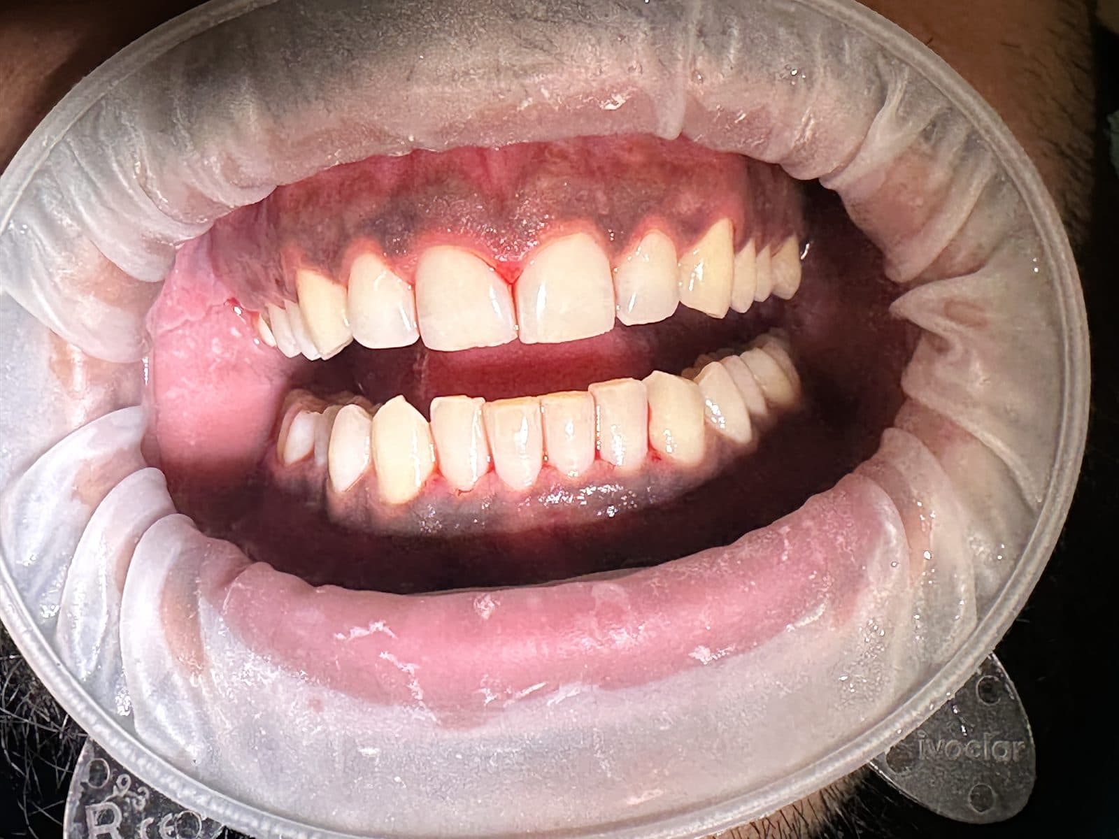 After: close-up of teeth and gums