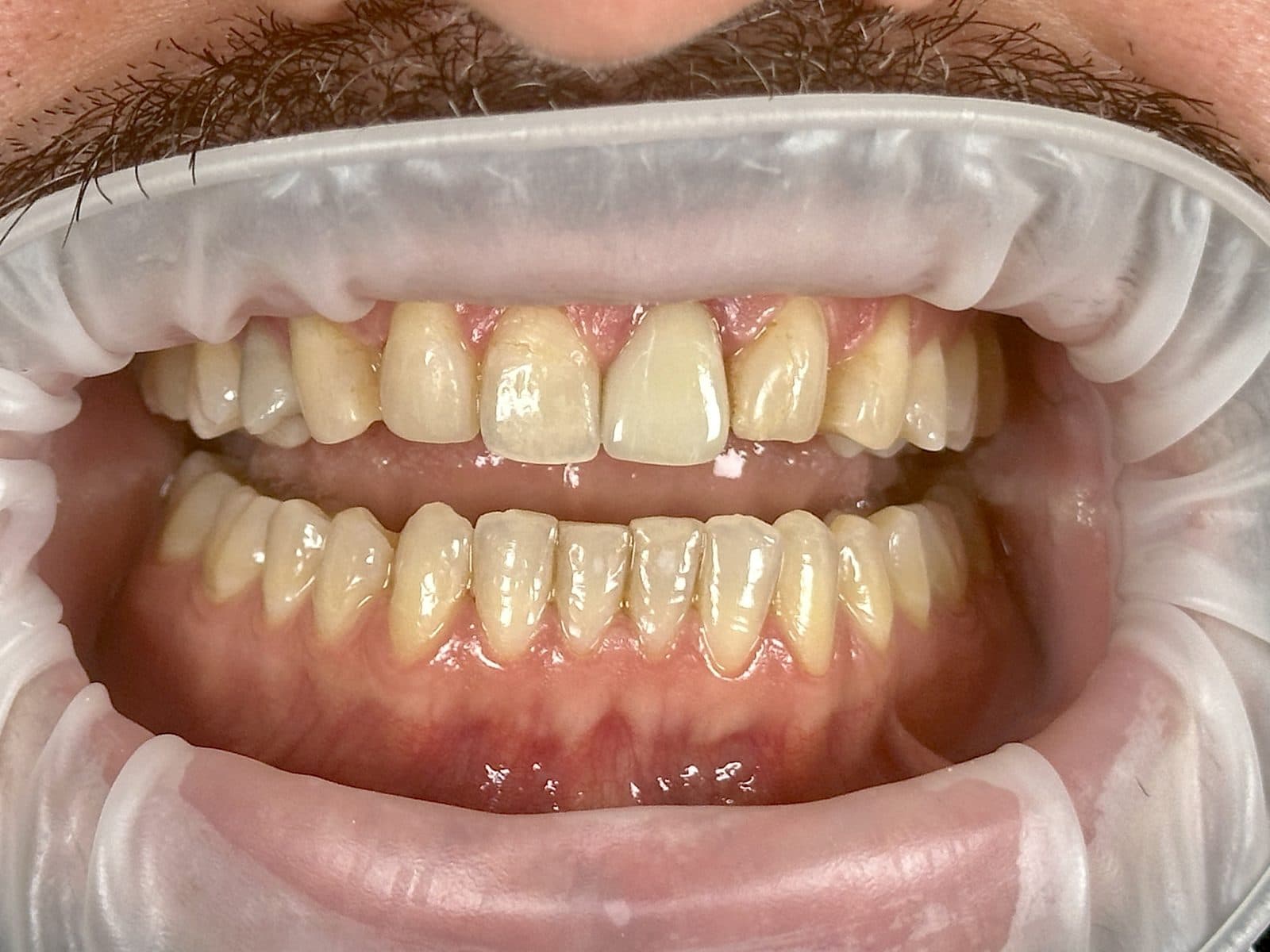 Before: close-up of teeth and gums