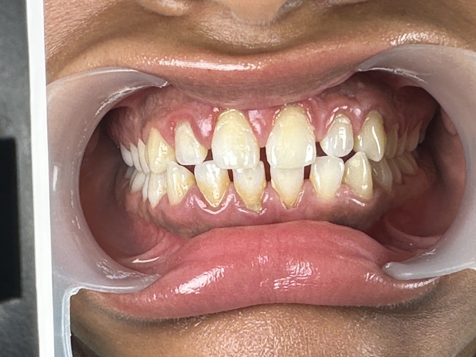 Before: close-up of teeth and gums