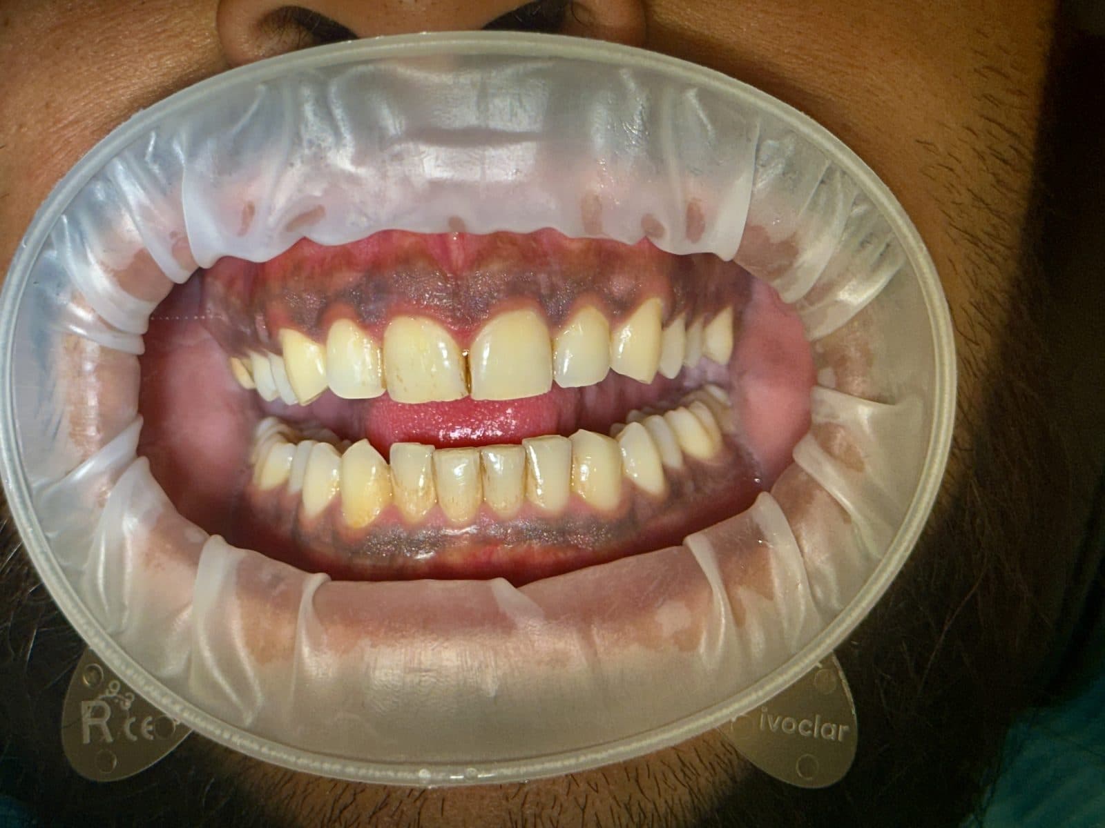 Before: close-up of teeth and gums